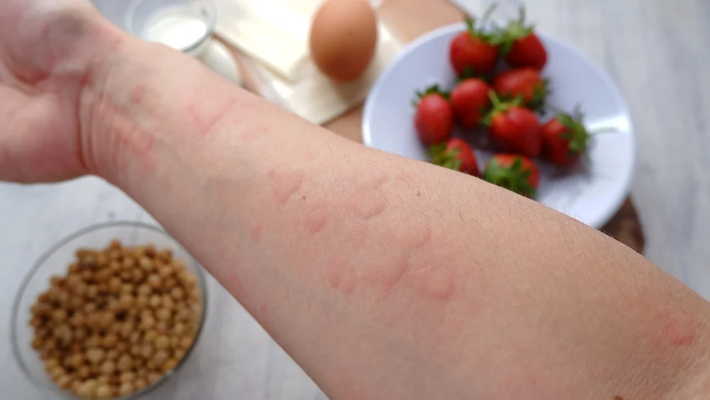 what-to-eat-for-allergies